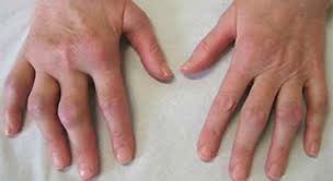 poliartrita este boala autoimuna medicamente pentru tratamentul artrozei de șold